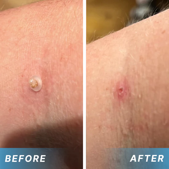 Painless Skin Tag Removal Pen – Home Precision Care Tool