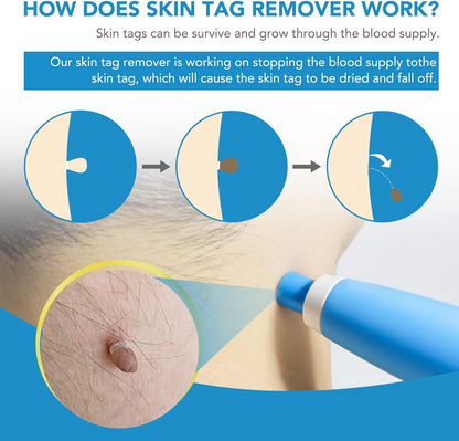 Painless Skin Tag Removal Pen – Home Precision Care Tool
