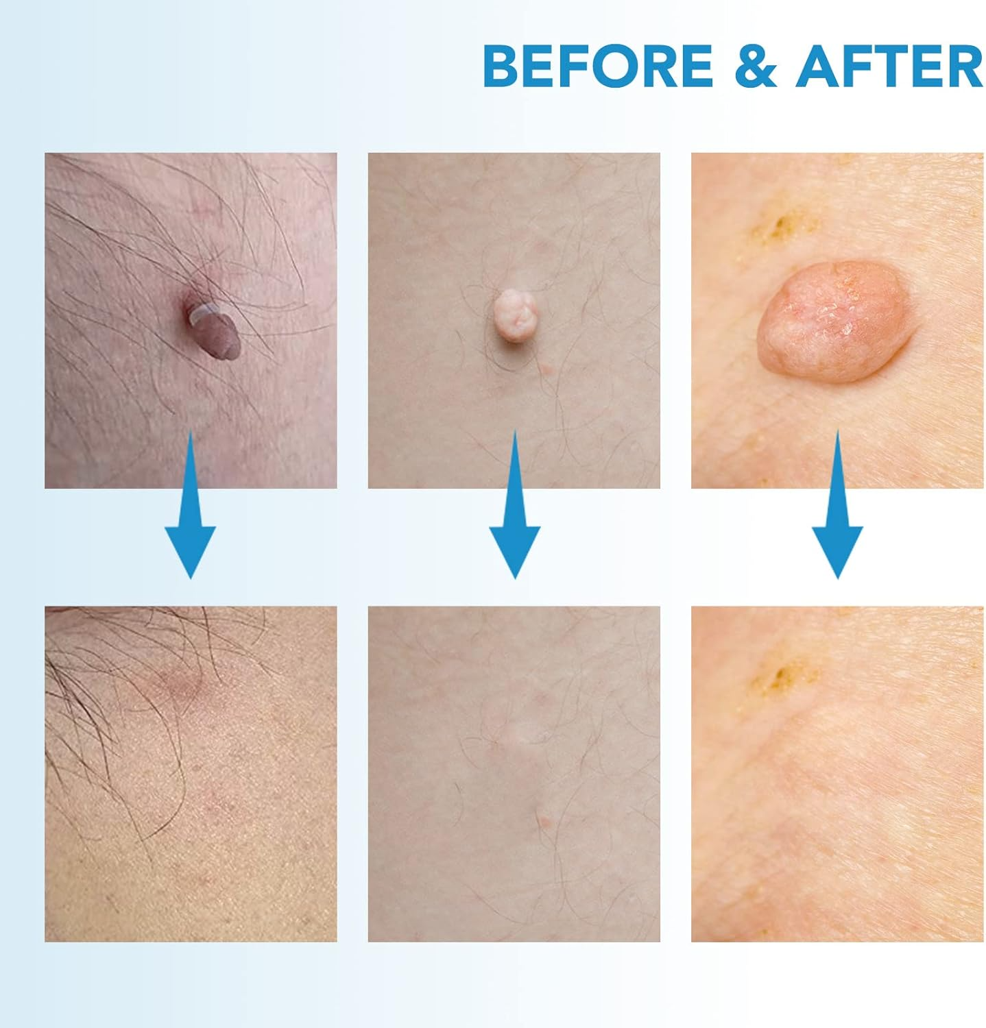 Painless Skin Tag Removal Pen – Home Precision Care Tool