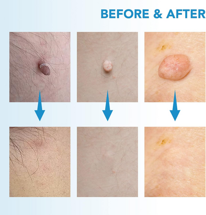 Painless Skin Tag Removal Pen – Home Precision Care Tool