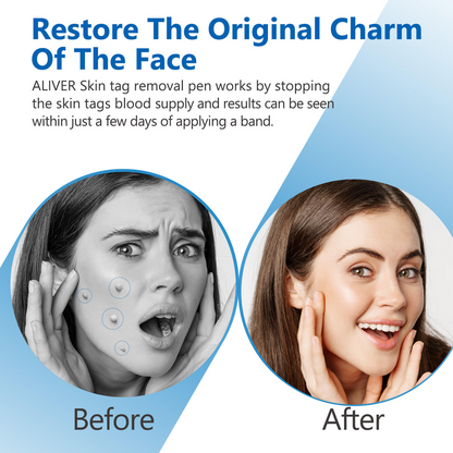 Painless Skin Tag Removal Pen – Home Precision Care Tool